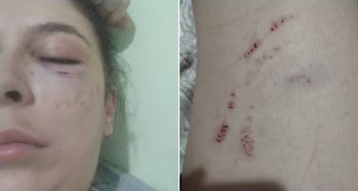 Carolina teve ferimentos no rosto e no braço que, segundo ela, foram causados pela vereadora Joice Guarino Lopes. (Foto: Arquivo pessoal)