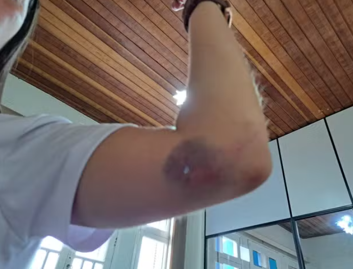 Vereadora Joice diz que teve ferimento no braço após copo ser arremessado em sua direção em Cerqueira César. (Foto: Joice Lopes/Arquivo pessoal)