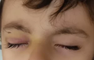 Campanha em Fartura arrecada fundos para cirurgia no olho de menino de 4 anos Raul terá de passar por cirurgia para não perder a visão. (Foto: Reprodução/Vakinha.com.br)