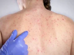 Rede de vigilância é essencial para evitar propagação de sarampo em SP Cobertura de 75% aumenta risco de novos surtos, alerta infectologista. (Foto: Divulgação)