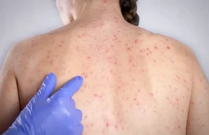 Rede de vigilância é essencial para evitar propagação de sarampo em SP Cobertura de 75% aumenta risco de novos surtos, alerta infectologista. (Foto: Divulgação)